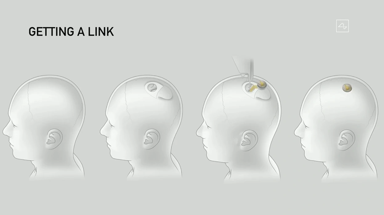 Neuralink forventer forsøg med mennesker inden for seks måneder