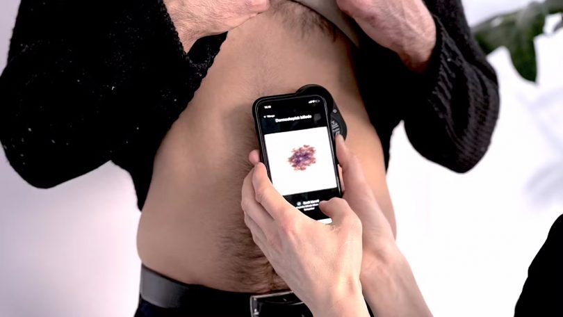 Ny dansk app kan opdage hudkræft